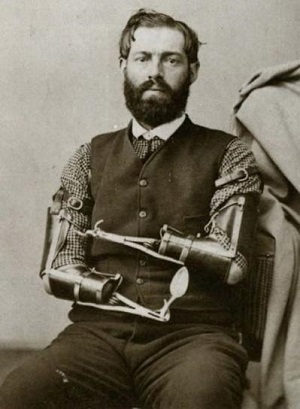 Homme possédant deux prothèses d'avant-bras. Il souhaitait avoir des sortes de couteaux suisse pour facilité ses travaux.