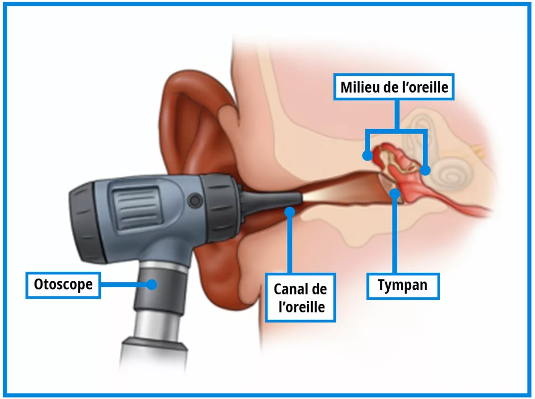 fonctionnement otoscope